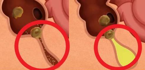 Appendix Bimari Kya Hai | Appendix के लक्षण, कारण, उपचार और बचने का तरीका